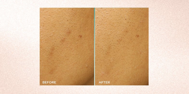 In Article How To Restore Radiance To A Dull Skin Tone Bright Reveal Peel